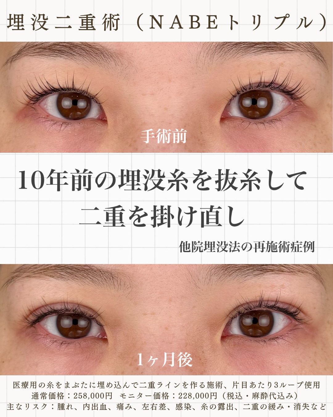 10年前の埋没法を抜糸して二重を掛け直しの画像